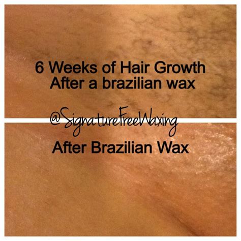 brazilian wax ingrown hair removal near me